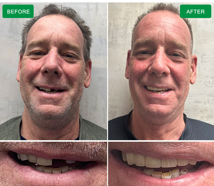 before and after
