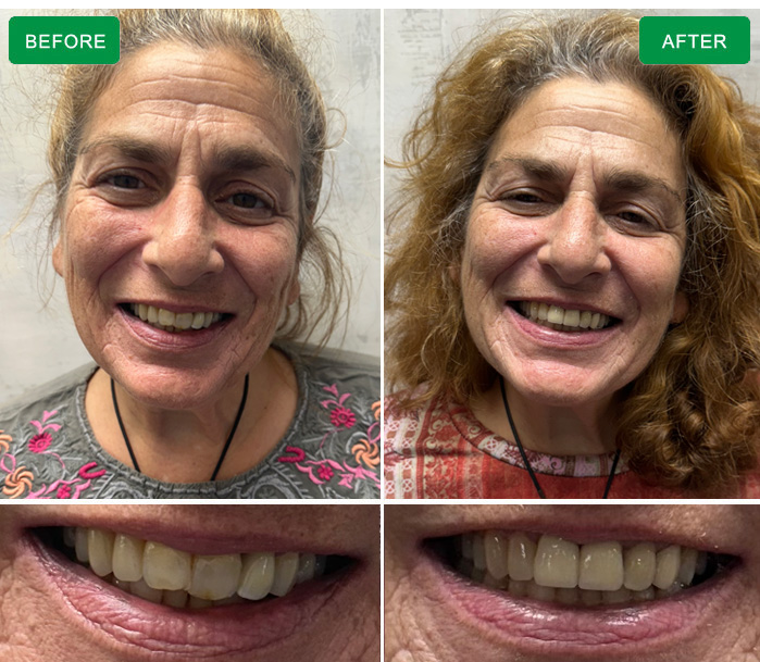 before and after