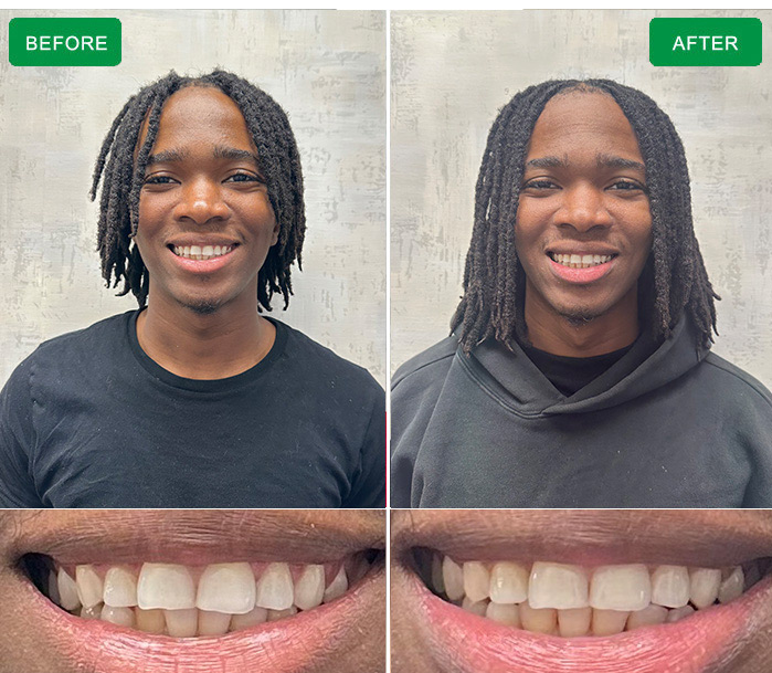 Clear Aligners in Philadelphia