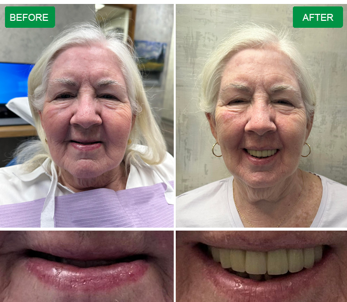 All on X Dental implants in Philadelphia
