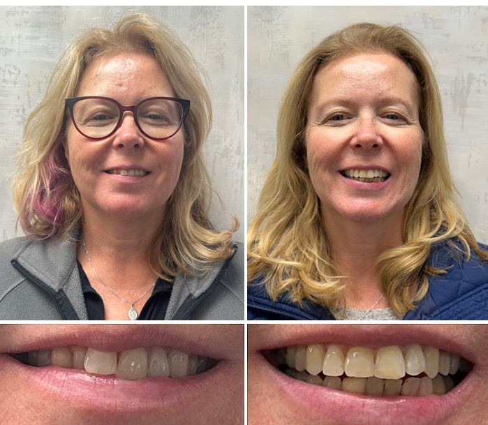 Invisalign in Philadelphia